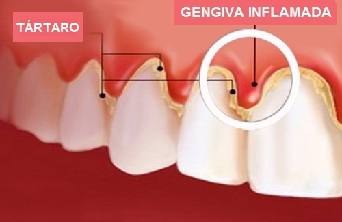 Clínica de Tratamento de Gengiva na Vila Eldízia - Clínica Dentista