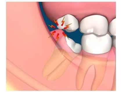 Orçamento para Cirurgia para Siso no Jardim Ipanema - Tratamento de Raspagem nos Dentes