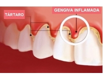 tratamento de raspagem periodontal no Centro